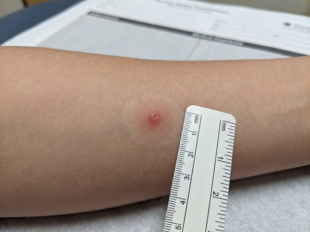 Close-up photo of a fresh sweat bee sting showing a small red raised bump with a pale white center on skin