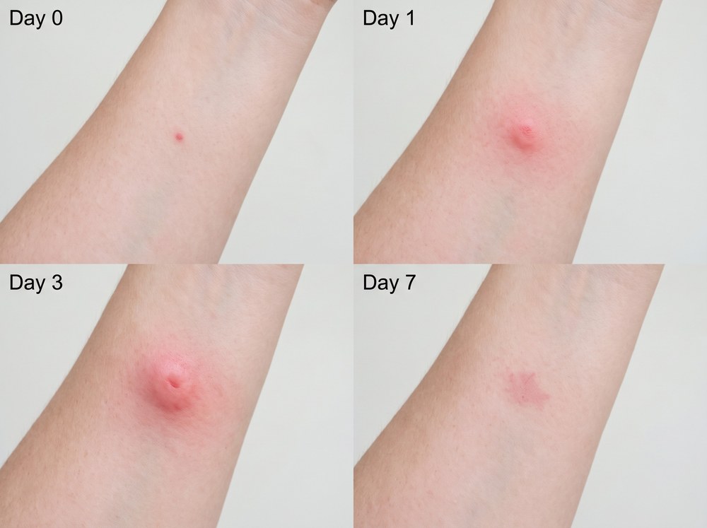 Side by side labeled comparison photo of a sweat bee sting mark next to a mosquito bite mark on human skin